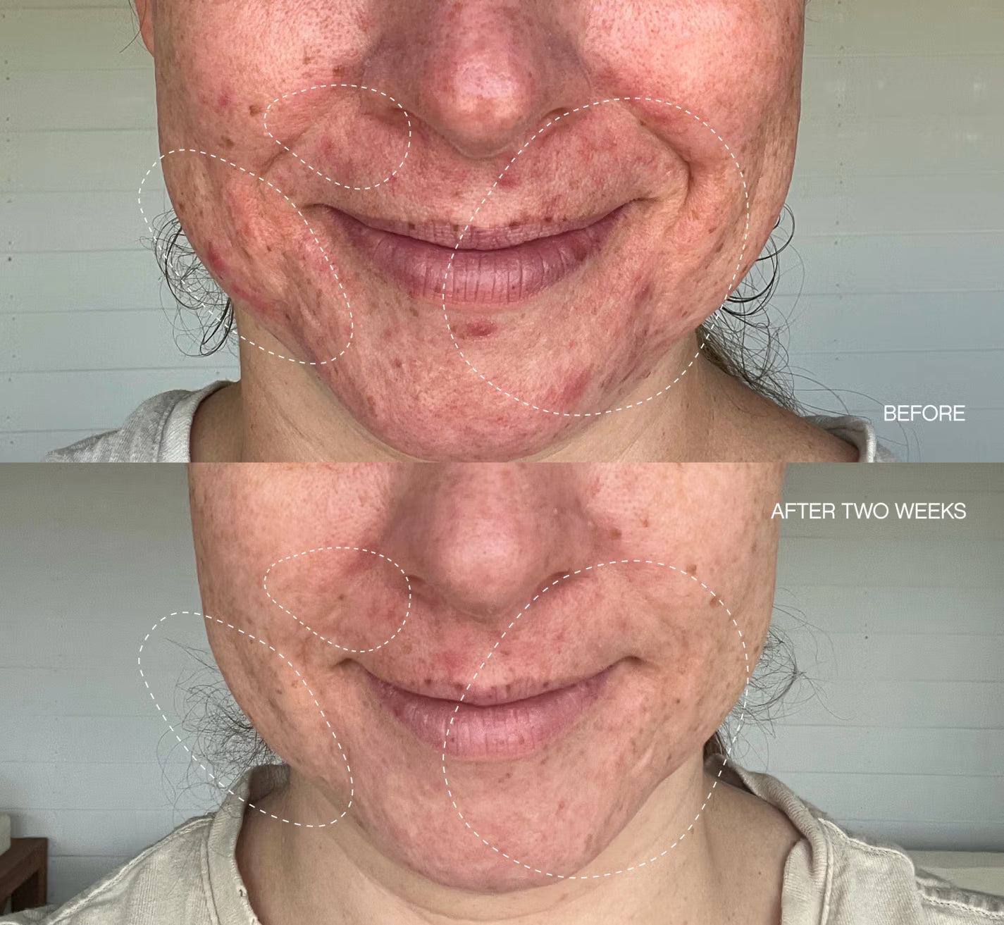 Clearly Blemish Mask